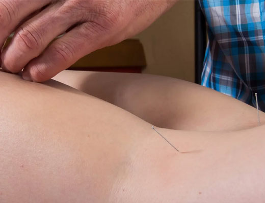 Scottsdale Electro Dry Needling by a Physical Therapist & Pricing